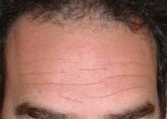 <p>the forehead</p>