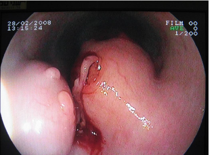 <p><span style="color: blue;"><em>Spirocerca lupi</em> </span>can cause what clinical signs?</p>