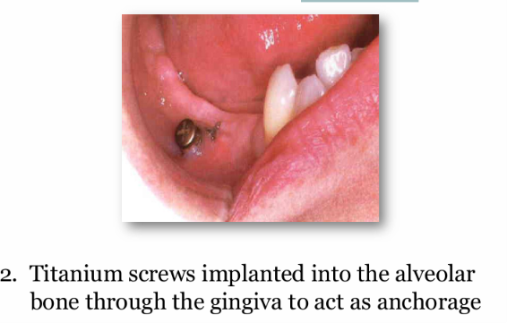 <p><u>Temporary anchorage devices:</u></p><p>What type of anchorage do they provide?</p><p>How is it attached?</p><p>How is it different to an implant?</p><p>what arches can it be used in?</p><p>What is it used in?</p>