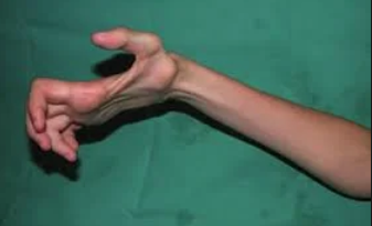 <p>Severe permanent flexion deformity of the hand and fingers caused by muscle damage from ischemia</p><p>The fracture compresses nerves and blood vessels which leads to claw hand deformity and complications of the supracondylar fracture</p>