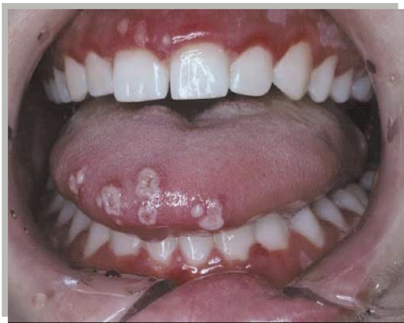 <p>what is this lesion and what is it associated with</p>
