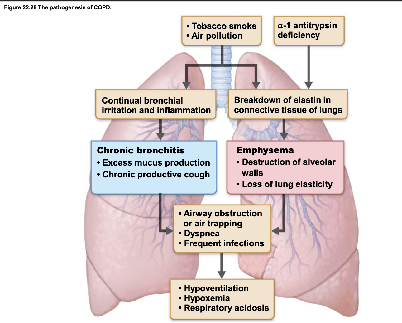 <p><strong>COPD</strong> is a chronic lung disease characterised by persistent airflow obstruction, making it difficult to exhale.</p><p></p><p><strong>1. Emphysema</strong></p><ul><li><p>Destruction of alveolar walls and loss of lung elasticity.</p></li><li><p>Causes <strong>air trapping, hyperinflation and reduced gas exchange</strong>.</p></li><li><p>May result in a flattened diaphragm and increased breathing effort.</p></li></ul><p></p><p><strong>2. Chronic Bronchitis</strong></p><ul><li><p>Chronic airway inflammation and excessive mucus production.</p></li><li><p>Narrows and obstructs airways.</p></li><li><p>Causes persistent productive cough and frequent respiratory infections.</p></li></ul><p></p><p><strong>Common effects of COPD:</strong></p><ul><li><p>Dyspnoea (difficulty breathing).</p></li><li><p>Reduced expiratory airflow.</p></li><li><p>Impaired gas exchange.</p></li><li><p>Possible hypoxaemia and respiratory acidosis.</p></li></ul><p></p><p><strong>Key point:</strong> Emphysema primarily damages the <strong>alveoli</strong>, while chronic bronchitis primarily affects the <strong>bronchial airways</strong>.</p><p></p>