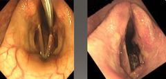 <p>What is this procedure for laryngeal hemiplegia?</p>