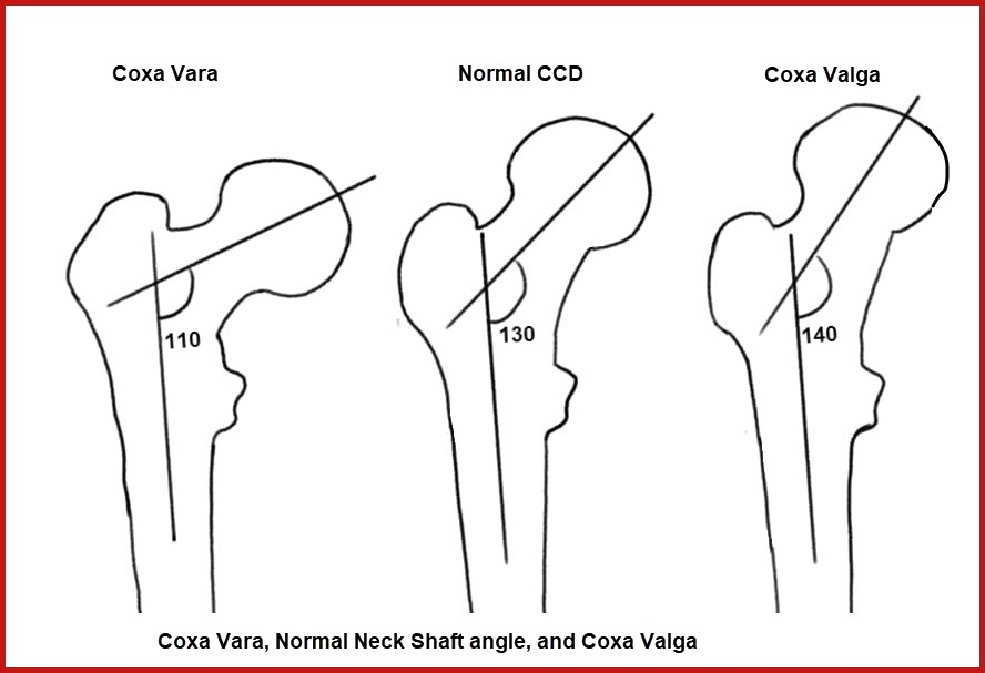 <ol><li><p>weak swing knee flexors</p></li><li><p>weak swing hip flexors</p></li><li><p>dorsiflexion weakness</p></li><li><p>knee extension contracture</p></li><li><p>spastic knee extensors</p></li><li><p>plantarflexion contracture</p></li><li><p>coxa valga</p></li></ol><p></p>