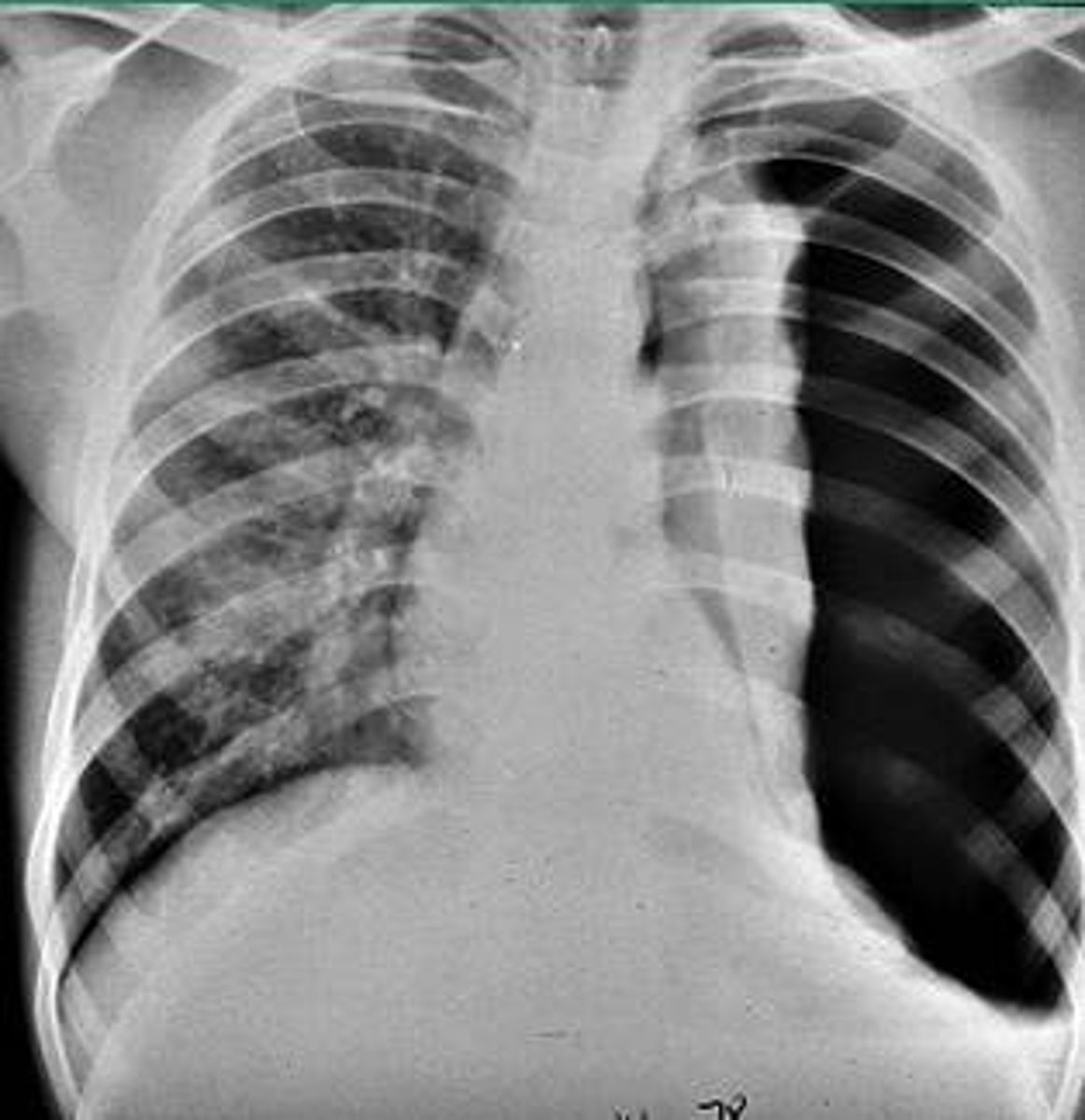<p>-condition of air/gas in the pleural cavity</p><p>-may cause lung to collapse</p>
