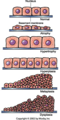 <p>cancerous, cells mutated completely</p>