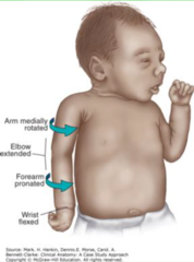 <p>- loss of sensation in the arm and paralysis and atrophy of the deltoid, biceps, and brachialis muscles </p><p>- the arm hangs by the side and is rotated medially; the forearm is extended and pronated (waiter's tip hand)</p>