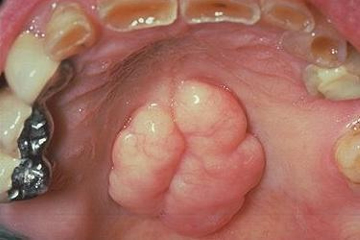 <p><span>This bony hard, radiopaque structure in the midline of the hard palate is diagnosed through clinical diagnosis. It is genetic and inherited in an autosomal dominant manner...</span></p>