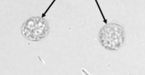 <p>Multi-lobed nuclei</p><p>“Glitter cells”</p><p>Seen with tubular damage, Infection, or Inflammation</p>