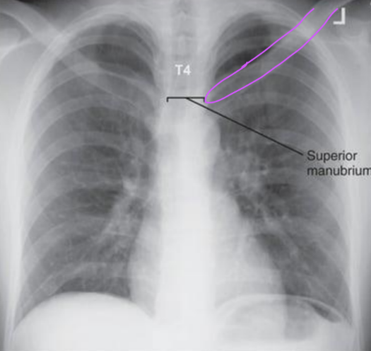 <ul><li><p>Lungs and heart are foreshortened</p></li><li><p>Vertical clavicles</p></li><li><p>Manubrium at T5 or lower</p></li><li><p>More than 1” of apices</p></li><li><p>Ribs are more curved</p></li><li><p>Upper MCP was tilted toward IR</p></li></ul><p></p>