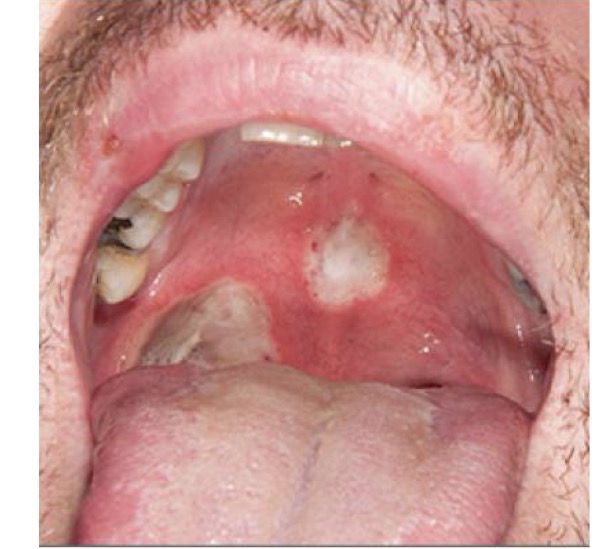 <p>BN CÓ VẾT LOÉT NHƯ HÌNH </p><p>CHẨN ĐOÁN </p>