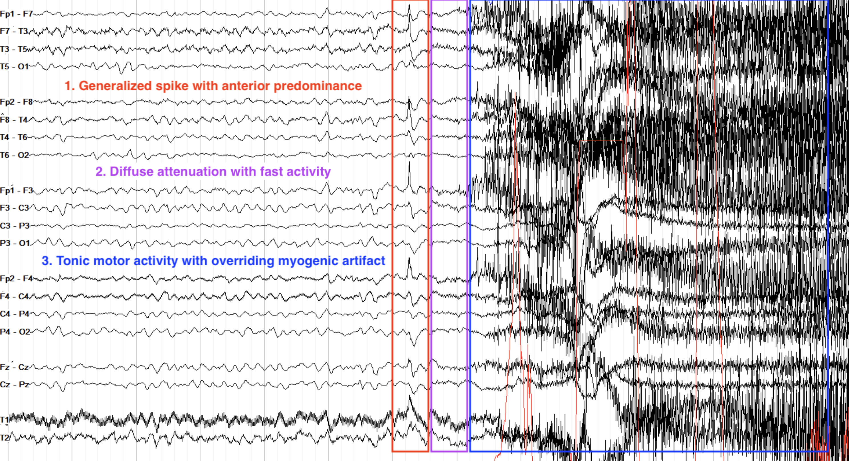 <p>spikes/jerks→ attenuation→regular</p>
