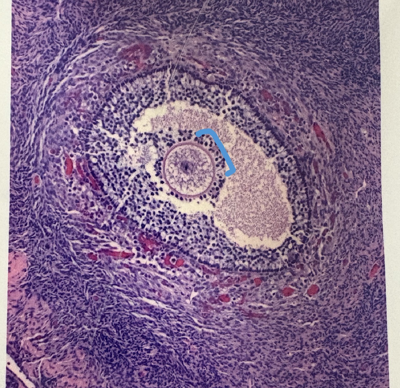 <p>“radiating crown” remaining cells around oocyte</p>