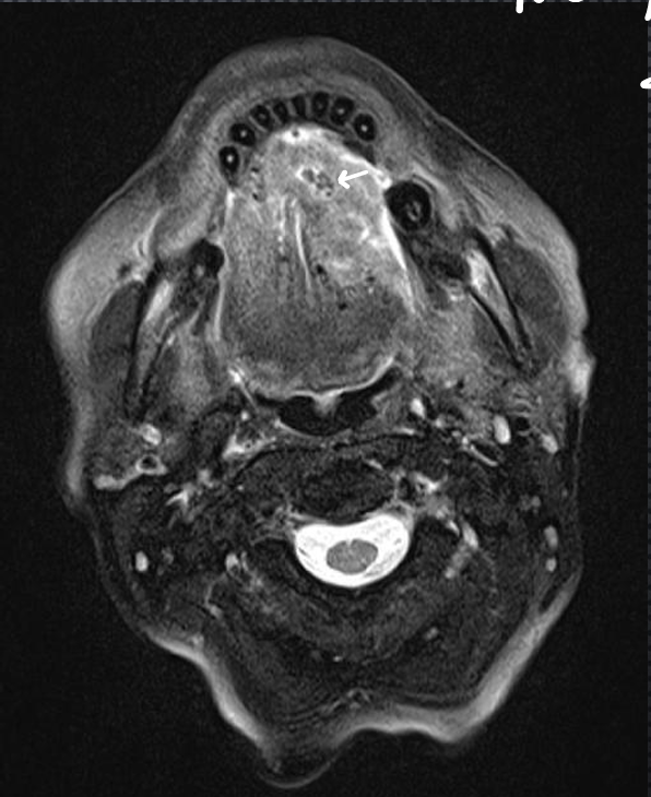 <p>*is this T1 or T2, and what is the itty bitty white arrow pointing at?</p>