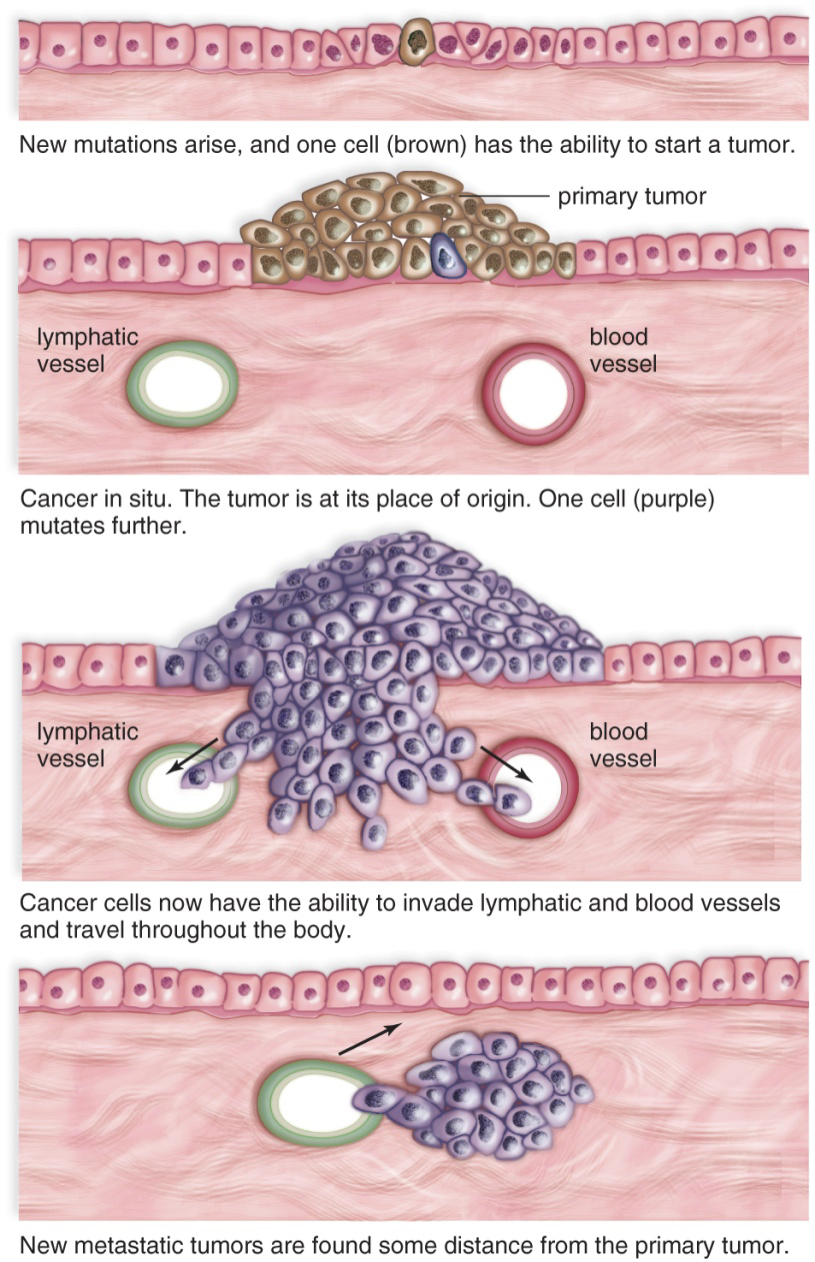 <ol><li><p><strong>Benign Tumors: </strong>(not cancer) tumor cells grow locally and cannot spread by invasion or metastasis. Won’t grow indefinitely, neighboring cells will send signal to stop. </p></li><li><p><strong>Malignant Tumors: </strong>(cancer) <strong>1. Local invasion</strong> and <strong>2. Metastasis.</strong> Cells will invade neighboring tissues, enter blood vessels, and metastasize to different sites. </p></li></ol><p>Surgical removal is not possible, chemotherapy is required to kill all rapidly diving cells. </p><p></p>