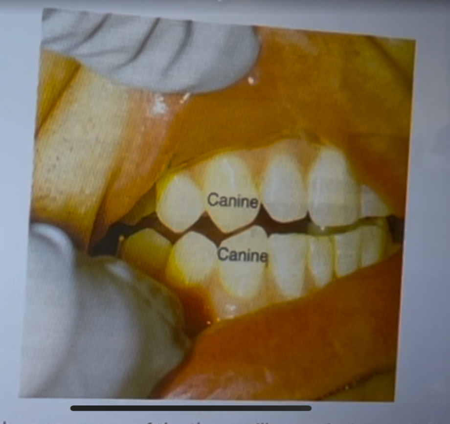 <p>it has attrition, the mesial cusp slope is longer than it should be, the patient is probably grinding his teeth, there is no attrition on the maxillary canine it is only on the mandibular canine, more than one of the above</p>