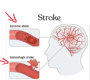 <p>cause: blockage or rupture in a brain artery</p><p>Effects on circulation: brain deprived of O2 = damage</p><p>treatment: control BP, avoid smoking </p>