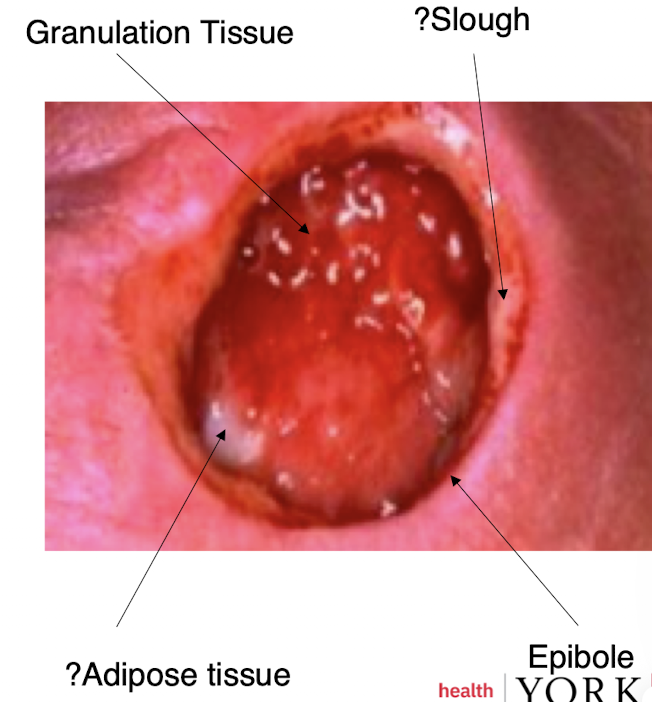 <p>Full-thickness skin loss extending into subcutaneous tissue.</p>