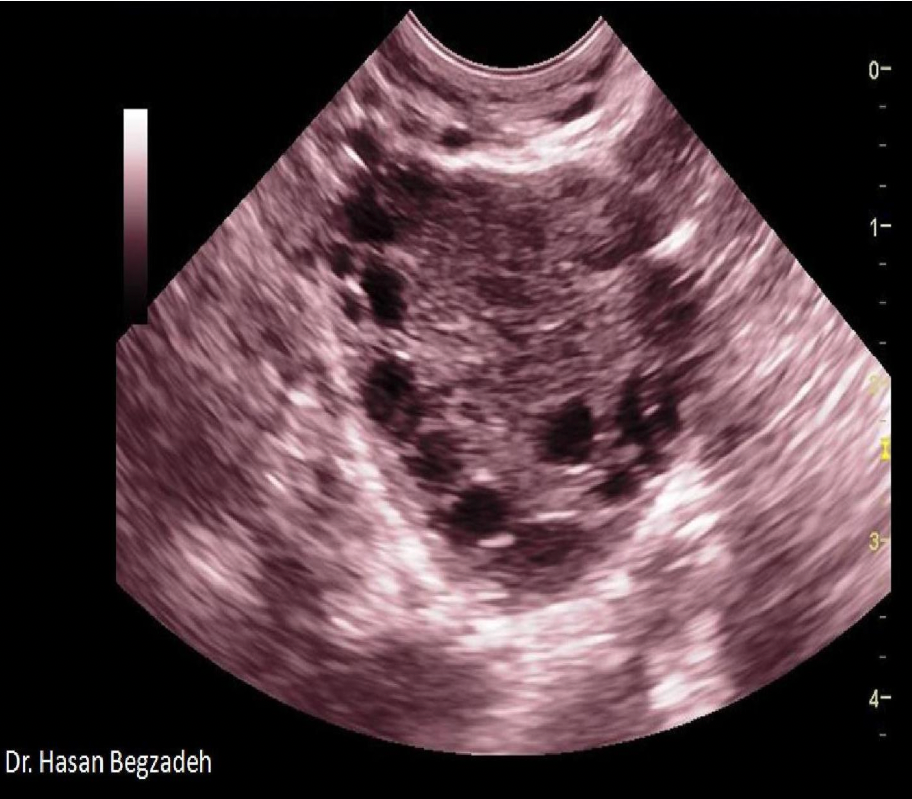 <p>All of the following are associated symptoms/complications related to the findings displayed on the image, except:</p><p>A. Infertility</p><p class="p1">B. Hirsutism</p><p class="p1">C. Alopecia</p><p class="p1">D. Amenorrhea</p>