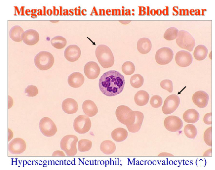 <p>Hypersegmented neutrophils</p>