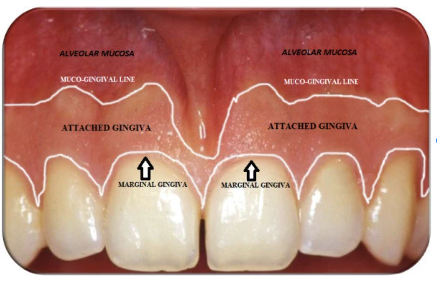 <p>⢠Continuous with the marginal gingiva</p><p class="p1">⢠Extends from the external surface of the base of the sulcus to the mucogingival junction</p><p class="p1">⢠Firm, resilient and tightly bound down to the underlying bone</p><p class="p1">⢠Width varies in different areas of the mouth </p>