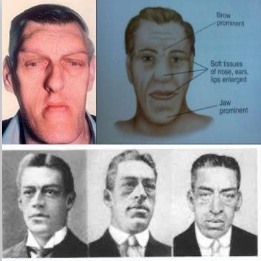 <p>Acromegaly</p>