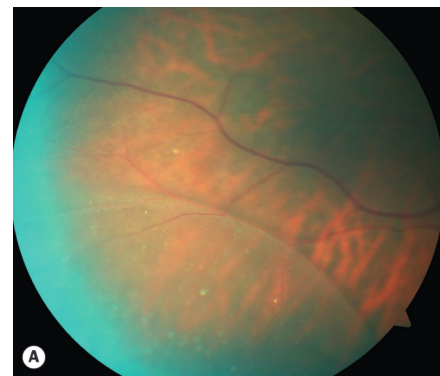 <ul><li><p>Splitting the retina at the outer plexiform layer</p></li><li><p>Causes an absolute visual field defect</p></li><li><p>Most common inferior + temporal</p></li></ul><p></p>