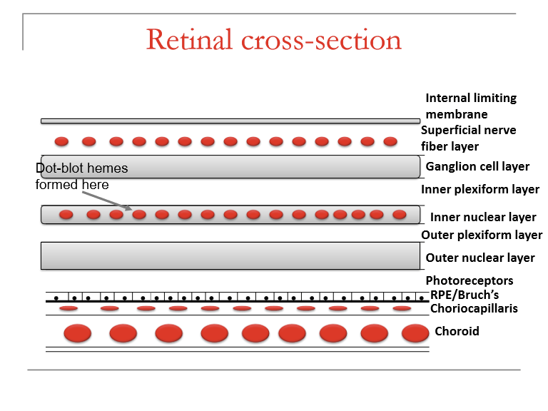 <p>Dot‑blot hemorrhages occur in deeper retinal layers:</p><ul><li><p>Inner nuclear layer (INL)</p></li><li><p>Outer plexiform layer (OPL)</p></li><li><p>Sometimes the outer nuclear layer (ONL)</p></li></ul><p>They follow the contours of retinal architecture, giving them their round/blot-like shape.</p><p></p>