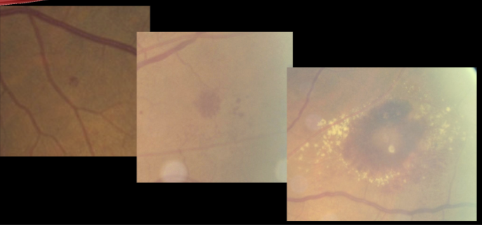 <p>Pathophysiology of intraretinal hemes (dot/blot hemorrhage)</p>
