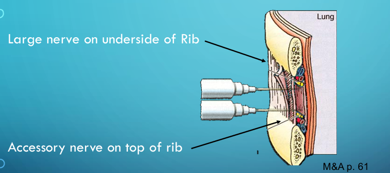<p><strong>Intercostal nerve block:</strong><span> Involves injecting anesthesia to target the large nerve on the underside of the rib</span></p>