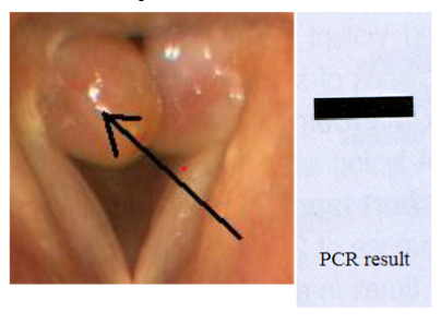 <p><span style="color: rgb(255, 252, 252);">A patient comes to your clinic with the structures shown below on his vocal cords. You take a biopsy of the structure indicated by the arrow. PCR primers are prepared complementary to the 3' ends of a bacterial gene, and a reaction is performed on the biopsied tissue. The results are shown after electrophoresis. What is the best interpretation of this data?</span></p><p><span style="color: rgb(255, 252, 252);">A. The PCR has been done wrong. One primer should be complementary to the 3' end and the other should be complementary to the 5' end of the gene.</span><span style="color: rgb(255, 252, 252);"><br></span><span style="color: rgb(255, 252, 252);">B. The patient's macrophages are in the process of digesting the bacteria and releasing the DNA.</span><span style="color: rgb(255, 252, 252);"><br></span><span style="color: rgb(255, 252, 252);">C. The patient has a granuloma, and may need long term antibiotics to treat it.</span><span style="color: rgb(255, 252, 252);"><br></span><span style="color: rgb(255, 252, 252);">D. The patient has a tumor, which was caused by insertion of bacterial DNA.</span><span style="color: rgb(255, 252, 252);"><br></span><span style="color: rgb(255, 252, 252);">E. The bacterium is actively replicating its DNA, which was detected by the PCR.</span></p>