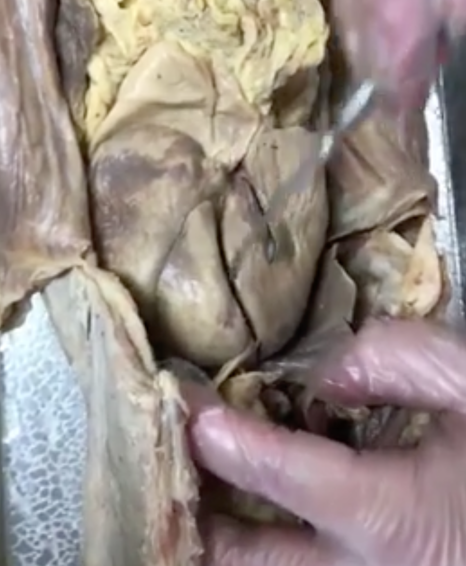 <p>what organ is prong pointing to</p>