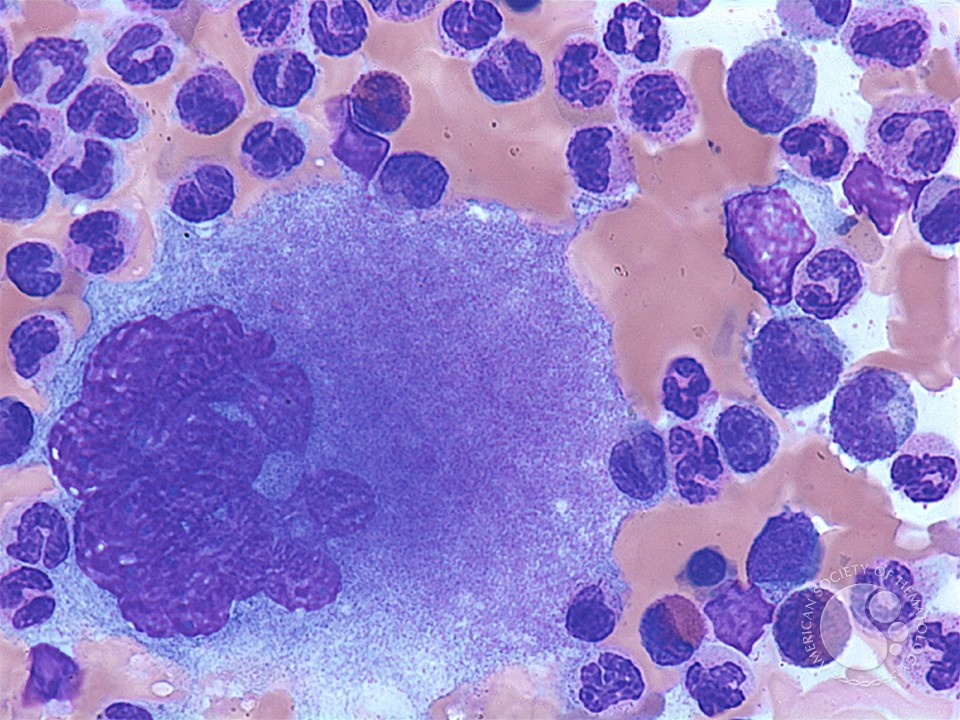 <p>what is granular megakaryocyte?</p>