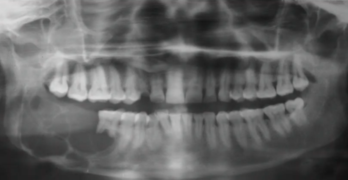 <p>if diagnosis comees back as ameloblastoma, what is the MANGAEMENT? </p>