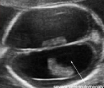 <p>What is the anomaly visualized in this image?</p><p>a. Hydranencephaly</p><p>b. Dandy-Walker malformation</p><p>c. Hydrocephalus</p><p>d. Holoprosencephaly</p>