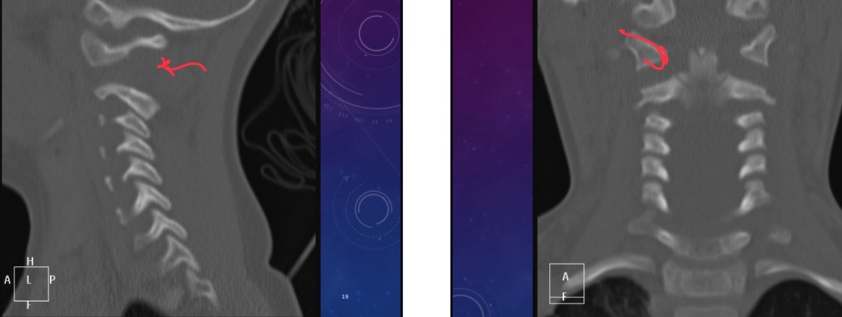 <p>Three-year-old female was in a motor vehicle accident and is in GCS 3. (Coma). What does this cervical spine xr show</p>