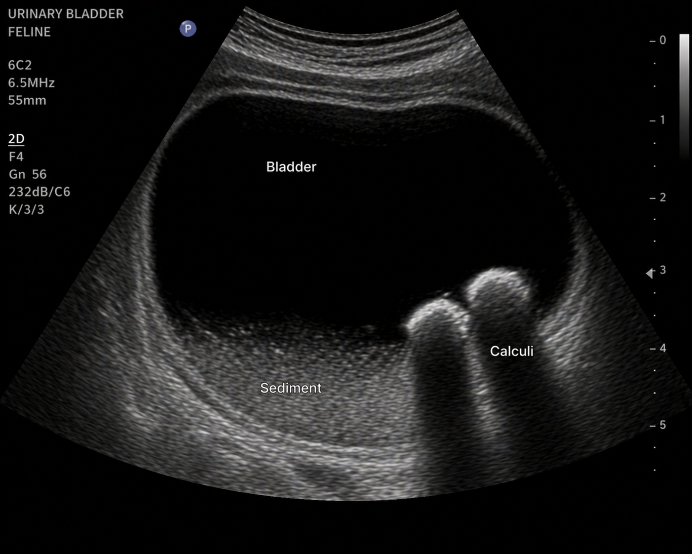 <p>Mochi presents for evaluation of vomiting. An abdominal ultrasound is performed.</p><p>During the scan, the clinician notes a bright hyperechoic linear structure at the far margin of the liver, corresponding to the diaphragm and adjacent lung.</p><p>A student asks, “Why is that boundary so bright? The liver parenchyma looks relatively gray—why does that interface stand out so much?”</p><p>As the examination continues, a small pocket of free fluid is identified adjacent to the liver. Another student observes, “I can see the liver margin outlined by the fluid, but the fluid–liver boundary is much less bright than the diaphragm–lung boundary. Why is that?”</p><p>The clinician asks both students to explain the difference using principles of acoustic impedance and ultrasound reflection.</p><p>Feline urinary bladder ultrasound - Mochi</p><p></p><p><strong>Which explanation best justifies why ultrasound is the most appropriate initial modality for this clinical question — and identifies the specific capability that makes it superior to both radiography and MRI in this scenario?</strong></p><p>a. Ultrasound is appropriate because MRI cannot image the urinary bladder — the magnetic field is incompatible with the fluid-filled structure. Ultrasound is the only modality that can evaluate hollow viscera.</p><p>b. Ultrasound is appropriate because it uses no ionizing radiation, making it the safest modality for any patient. Radiography and MRI both use ionizing radiation and should be avoided in cats whenever possible.</p><p>c. Ultrasound is appropriate because feline urinary calculi are always radiolucent on radiography and therefore invisible, making radiography non-diagnostic for urinary obstruction in cats.</p><p>d. Ultrasound is the appropriate initial modality because it provides real-time imaging — allowing direct observation of intraluminal material behavior as the patient is repositioned. This distinguishes mobile sediment and matrix (which shift with gravity) from fixed calculi (which remain stable), and allows simultaneous assessment of bladder wall thickness and ureteral jet function. Radiography cannot assess material mobility or bladder wall character in real time; MRI is impractical as an initial modality due to anesthesia requirements and acquisition time.</p><p></p>