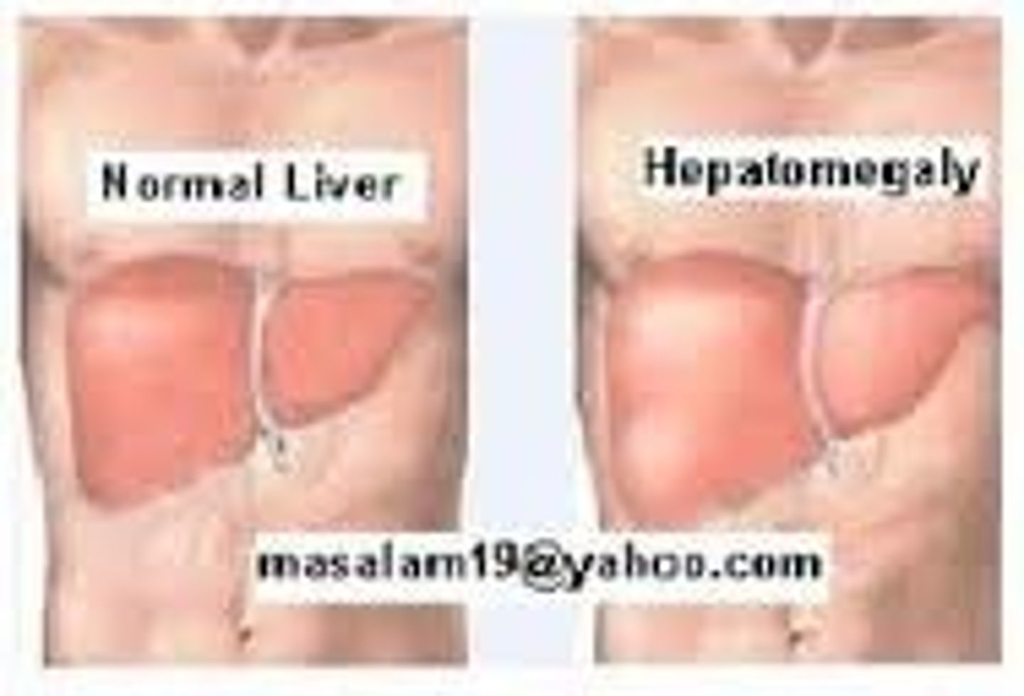 <p>hepatomegaly</p>