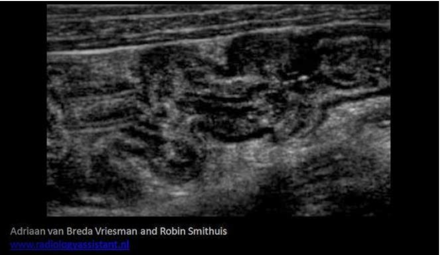 <p>A 50yr old male presents with RLQ pain, watery diarrhea and a low grade fever. The ultrasound exam demonstrates a prominent lymph node in the area of pain and the image below was also obtained at the area of pain. These findings are most consistent with?</p><p>A. Colitis</p><p class="p1">B. Irritable bowel syndrome</p><p class="p1">C. Intussusception</p><p class="p1">D. Appendicitis</p>