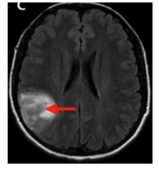 <p>D. Right parietal lobe</p>