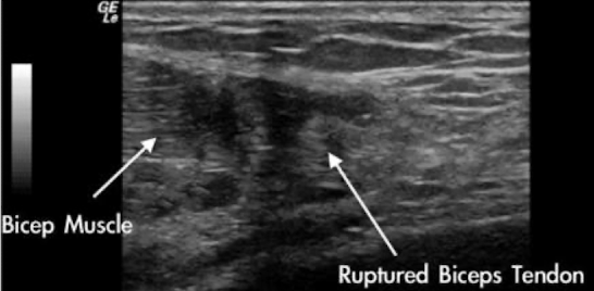 <ul><li><p>aka “tear”</p></li><li><p>S/S: significant pain; edema; fluid accumulation</p></li><li><p>SONO:</p><ul><li><p>partial tear=focal hypoechoic area within tendon </p></li><li><p>complete tear=anechoic or heterogeneous area within the tendon, indicative of hematoma</p><ul><li><p>complete ruptures also show shadowing in area of the separated tendon, with fat, a hematoma, or granulomatous material filling the gap created by the tear</p></li></ul></li></ul></li></ul><p>**MRI is gold standard</p><p></p>