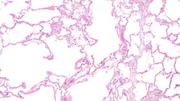 <p>Emphysema </p>
