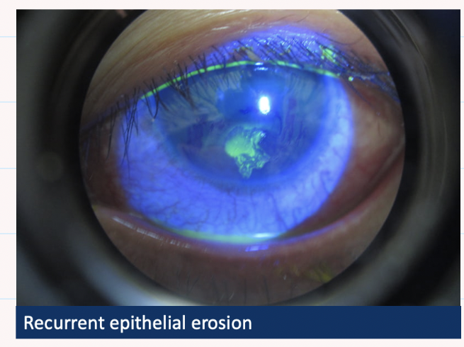 <ul><li><p>epithelial erosion , stains with fluoroescein → loose edges , slipped rug appearance </p></li></ul><p></p>