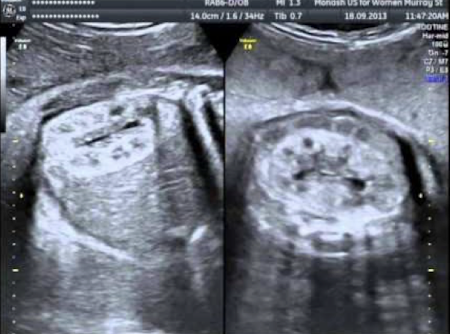 <ul><li><p>bilateral (rare unilateral)</p></li><li><p>similar to ARPKD</p></li><li><p>symmetrically enlarged echogenic kidneys</p></li><li><p><span style="color: red;">amniotic fluid may be normal</span></p><ul><li><p>unlike ARPKD, which has oligohydramnios</p></li></ul></li><li><p>visible bladder</p></li><li><p>kidneys may look normal in 2nd trimester; follow up if family hx of ADPKD</p></li></ul><p></p>