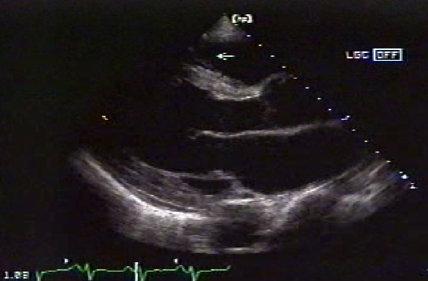 <ul><li><p>thick bundle of muscle traversing the <span style="color: rgb(0, 124, 255);">RV</span></p></li><li><p>variable size</p></li><li><p>often <u>verifies RV in fetal scanning</u></p><ul><li><p>seen in <strong>lower 1/3</strong></p><ul><li><p><u>more toward</u> <span style="color: rgb(0, 139, 255);">apex</span></p></li></ul></li></ul></li><li><p>not always visualized</p></li><li><p>may act as a protective mechanism to resist RV overdistension</p></li></ul><p></p>