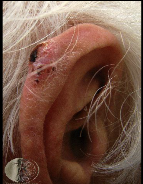 <p>deadliest form of skin cancer, can spread quickly to other body parts if not diagnosed early</p>