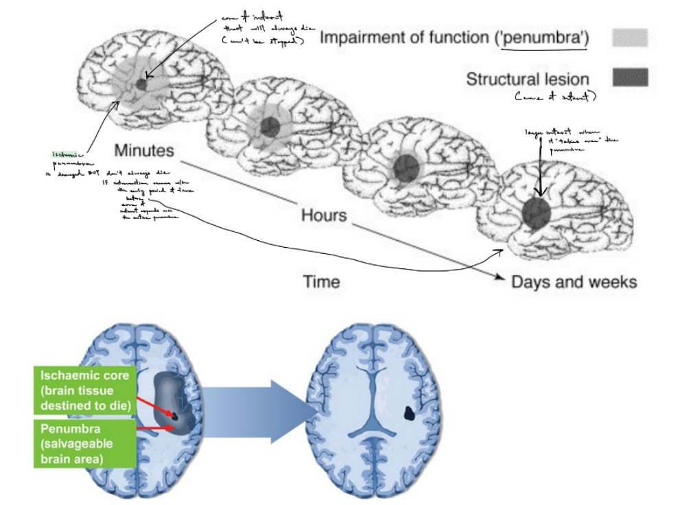 <ul><li><p><u>minutes </u>after the start of a stroke, will have a small infarct core surrounded by ischemic penumbra, where:</p><ul><li><p><u>cells in the core </u>will <u>always die</u> <span style="color: purple;">(← dead tissue, irreversible, <mark data-color="purple" style="background-color: purple; color: inherit;">death is via cell edema</mark>)</span></p></li><li><p><u>cells in the penumbra</u> is <strong><u>only partially damaged</u></strong> AND <strong><u>can be rescued/saved IF</u></strong><u> intervention/treatment occurs w/in an early period of time before the core expands to include the penumbra</u></p></li></ul></li><li><p>over <u>hours</u>, the core will expand to encompass/include the penumbra</p></li><li><p><u>days to weeks</u> after the start of a stroke, the <u>core takes over the penumbra completely</u>, SO <u>all the cells in the infarct will die</u></p></li></ul><p></p>