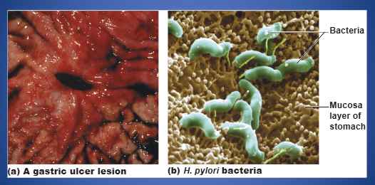 <p>erosion of the stomach wall (mostly caused by H. pylori bacteria)</p>