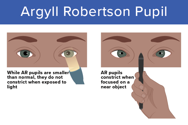 <p>pupil does not react to light (constrict with accommadation)</p>