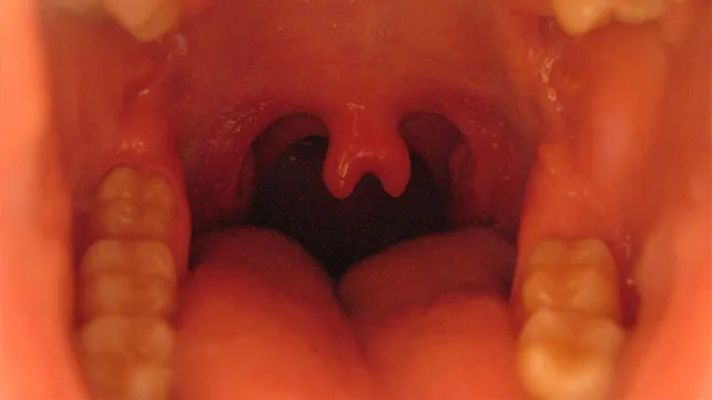 <p>What is the following picture an example of?</p><p>a) Bifid uvula</p><p>b) Normal uvula</p><p>c) Absent uvula</p><p>d) Cleft hard palate</p>